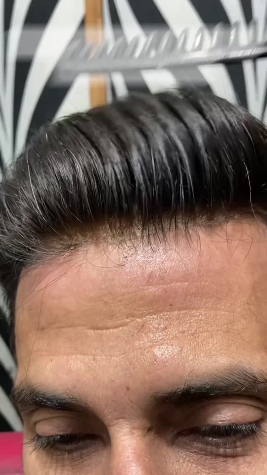 Very low density hair patch — TikTok reel thumbnail